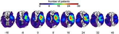 Revisiting the Neural Basis of Acquired Amusia: Lesion Patterns and Structural Changes Underlying Amusia Recovery